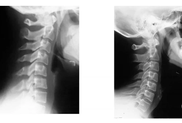 Torque Release Technique Greenville SC Xrays